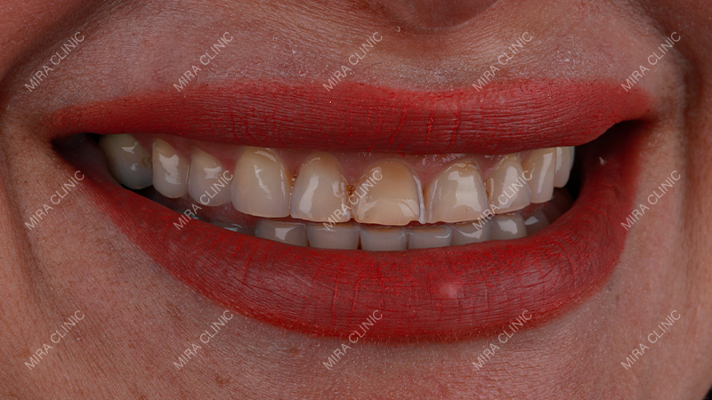 Straight Teeth
